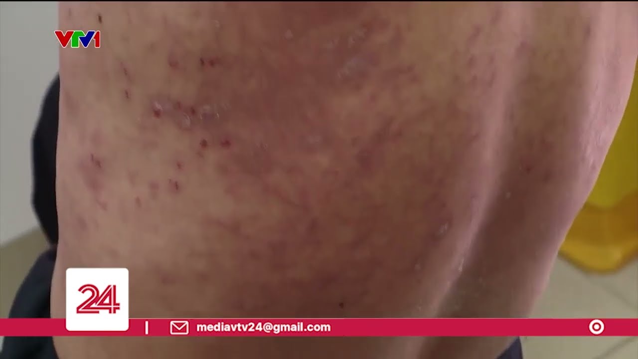 Thời tiết nồm ẩm, nhiều người mắc bệnh da liễu | VTV24