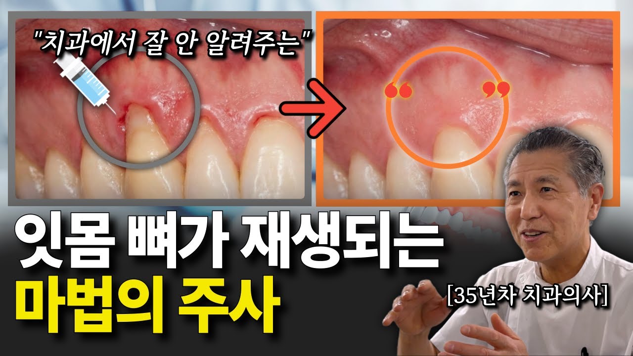 풍치(치주염)에 걸렸을 때 이 주사 한 방이면 뼈가 재생됩니다.