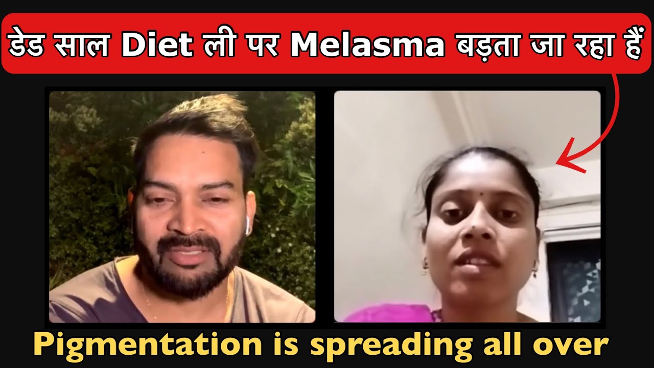 डेड साल Diet ली पर Melasma बड़ता जा रहा हैं l Pigmentation is spreading all over my face, What to do