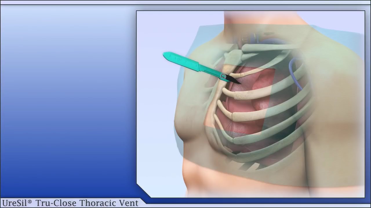 Uresil Tru-Close Thoracic Vent