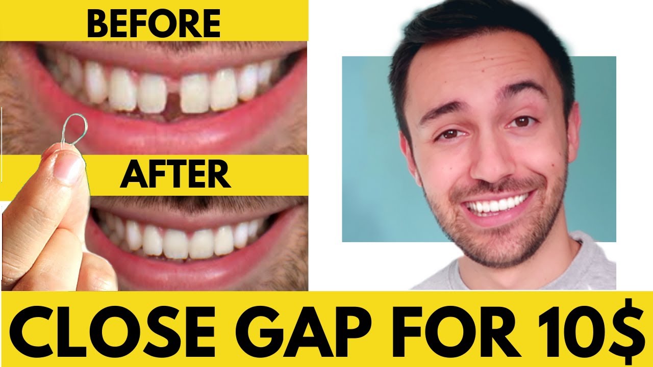 CLOSE Gap Teeth FAST with Rubber Bands AT HOME (Cheap & Easy DIY)