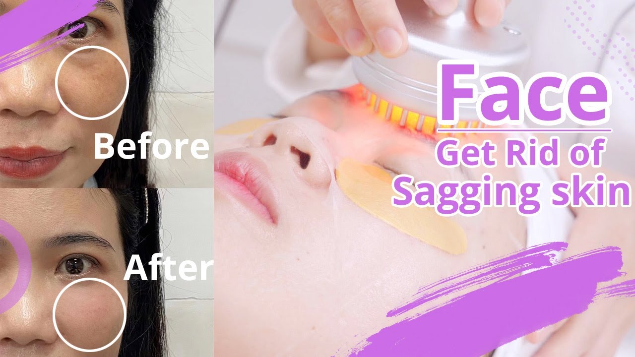 RF Skin Tightening | Wrinkle Removal | RF Wrinkle Removal Machine | Anti Wrinkle Skin Rejuvenation