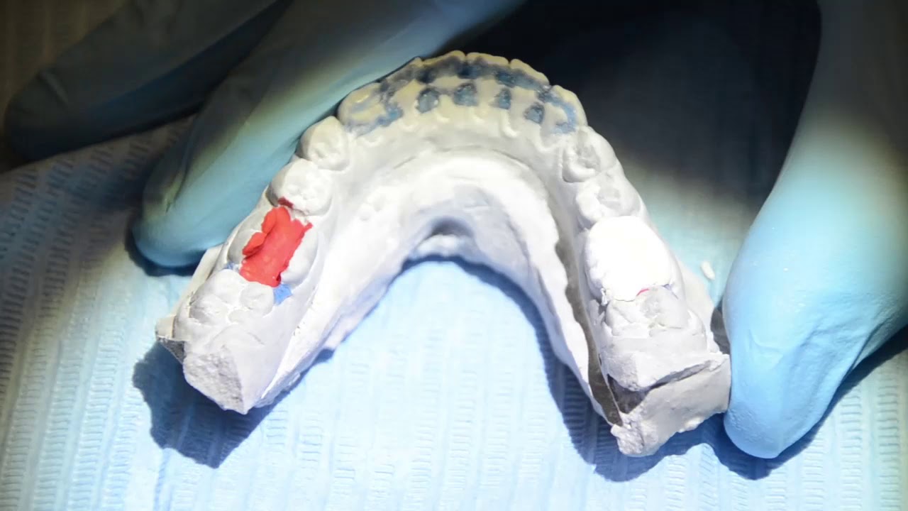 The Old Surgery Dental Practice Crewe - Fitting a temporary filling