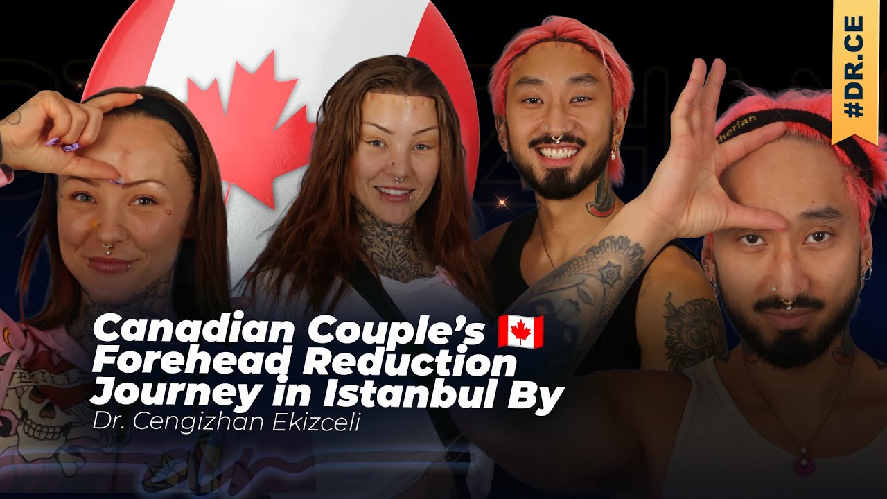 Not Just Love… The Same Surgery Too! Couple’s Forehead Reduction in Turkey 👩‍❤️‍👨✨
