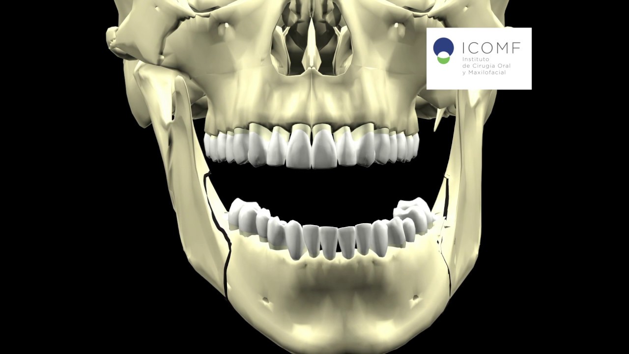 ASIMETRIA MANDIBULAR CIRUGIA MONOMAXILAR