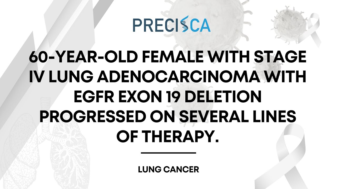 Expert Cancer Panel: Stage IV lung cancer with EGFR exon 19 del, progressed on several treatments