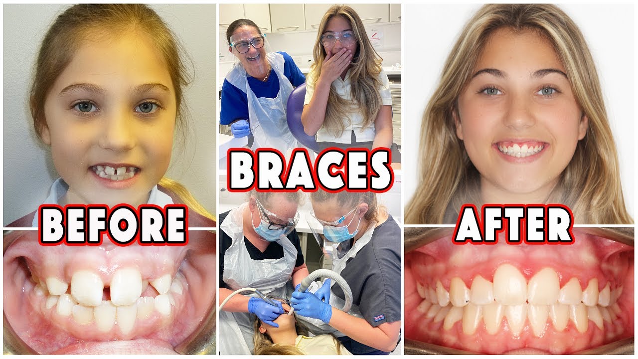 Getting BRACES Before And After | Rosie McClelland