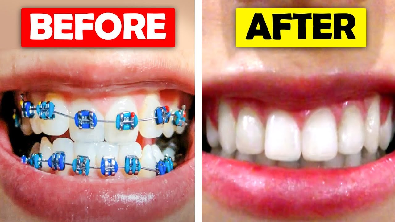 Full Braces Time Lapse | Before & After...Orthodontist Reacts