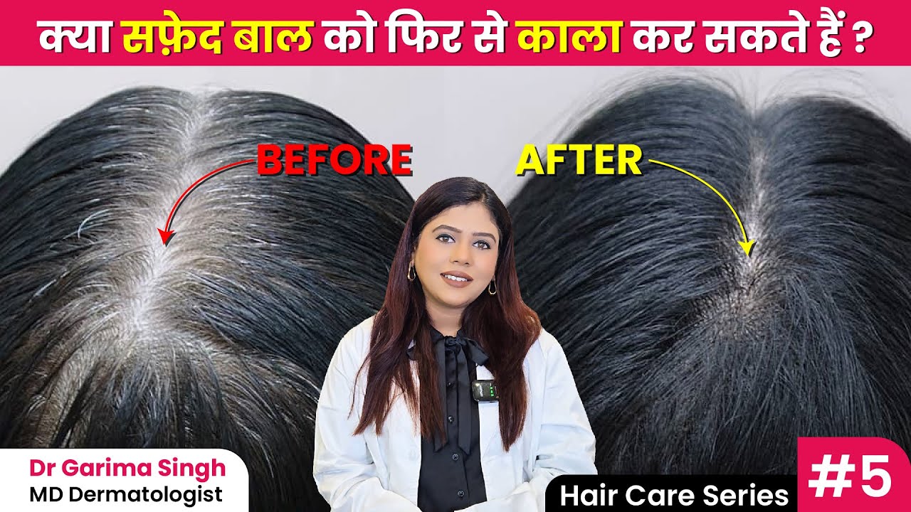 Kam Age Mein Safed Baal? ये हैं Scientific Reasons | Premature Grey Hair | Dermatologist