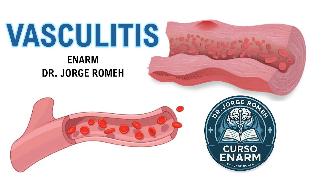 VASCULITIS - ENARM - TODO LO QUE DEBES SABER