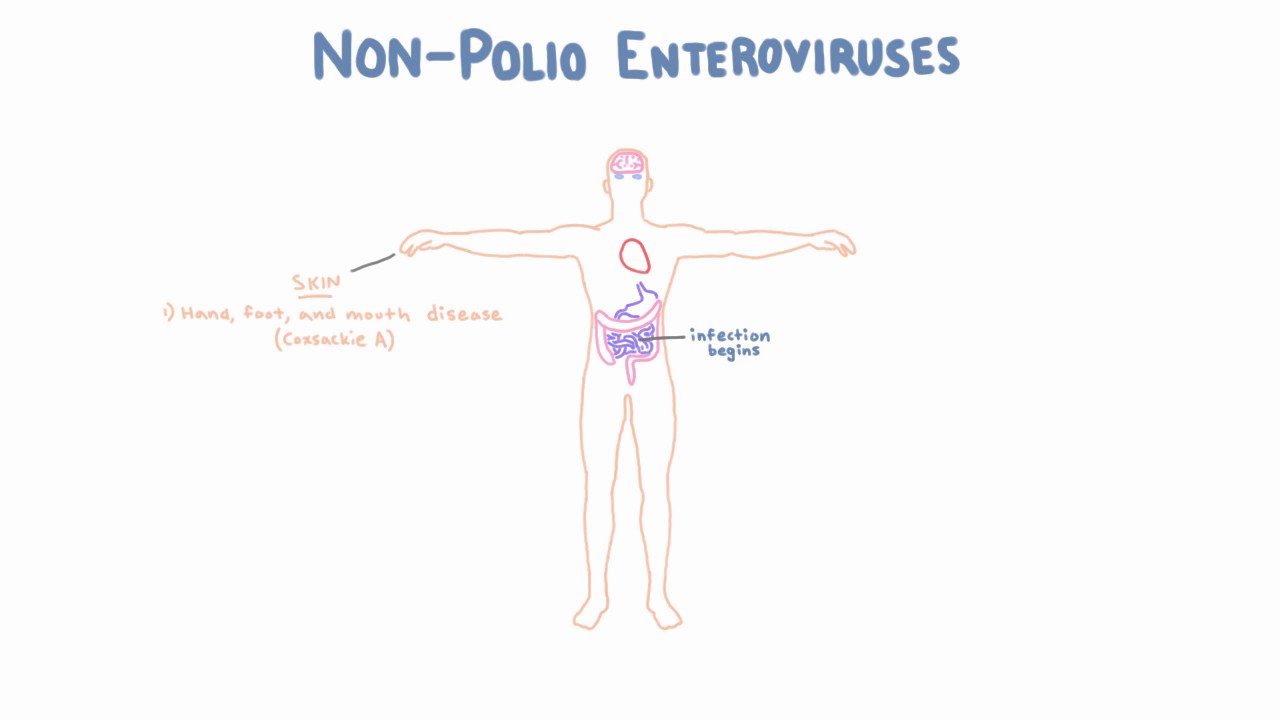 Non Polio Enteroviruses - Echovirus, Coxsackievirus, and Enterovirus