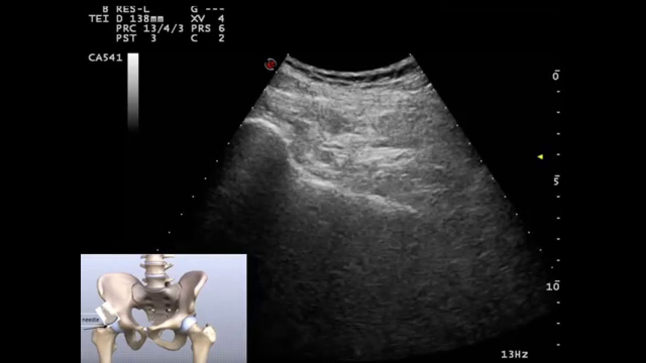 Ultrasound guided  hip viscosupplement   injection, by Murat Karkucak MD