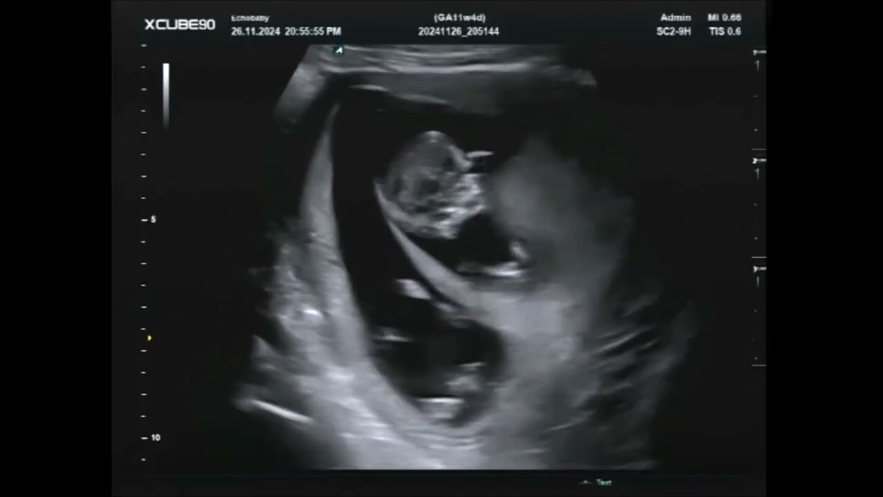 Pretecho 11 Weken Live Filmpje Tweeling