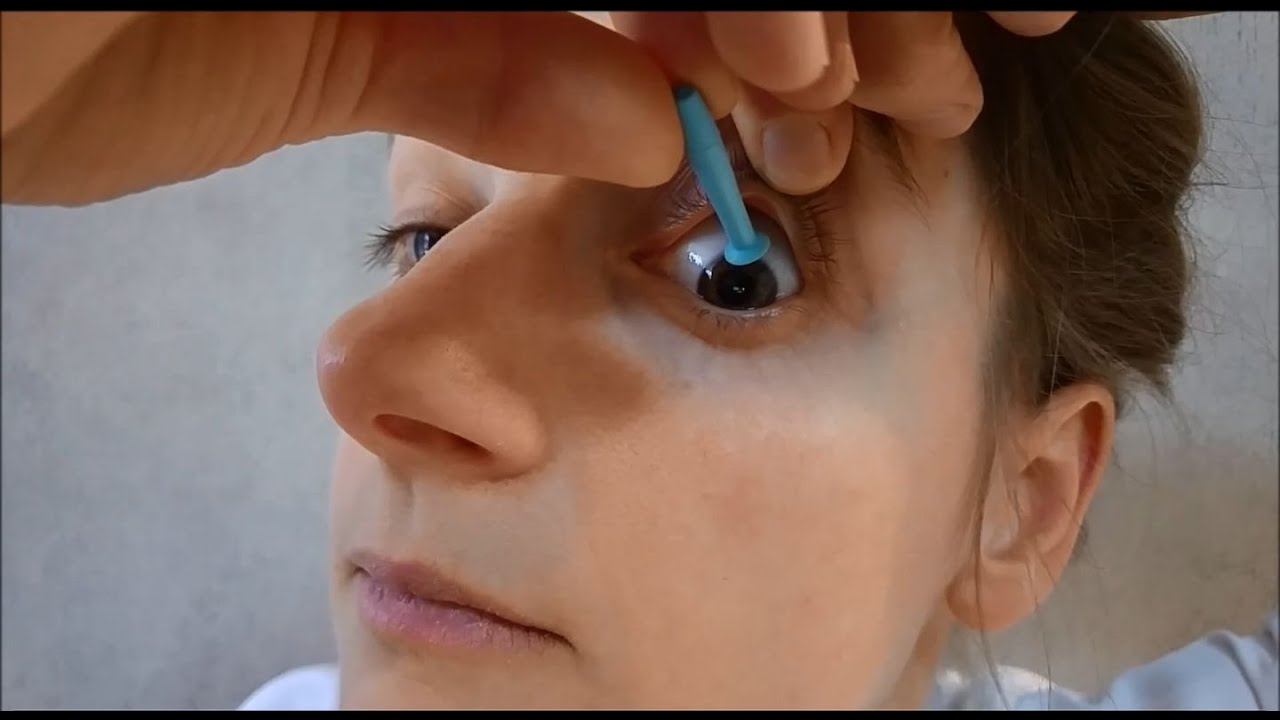 Wie bekomme ich eine hinter das Auge gerutschte Kontaktlinse wieder heraus?