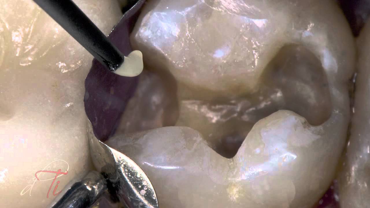 G-ænial: Class II Restoration - Developing Contour, Color & Contact (Video)