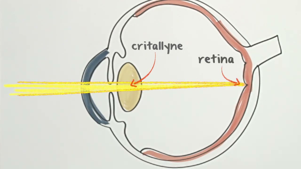 Trifocal Technology