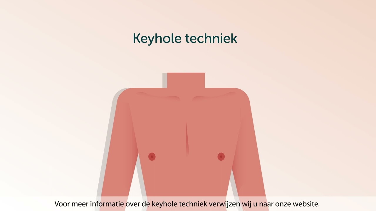 Mastectomie - de operatie