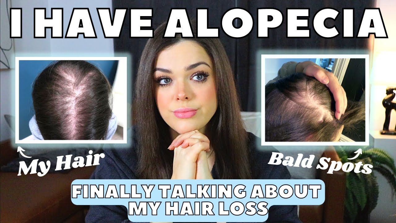 I Have Alopecia | Going Bald As a Woman | My Story With Pictures
