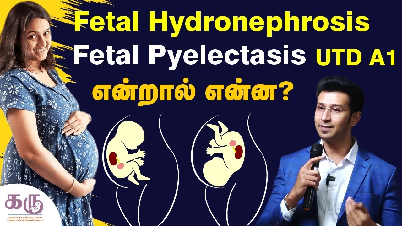 Fetal hydronephrosis | Fetal Pyelectasis | UTD A1 என்றால் என்ன? | Dr. Karthik Senthilvel | karu Scan