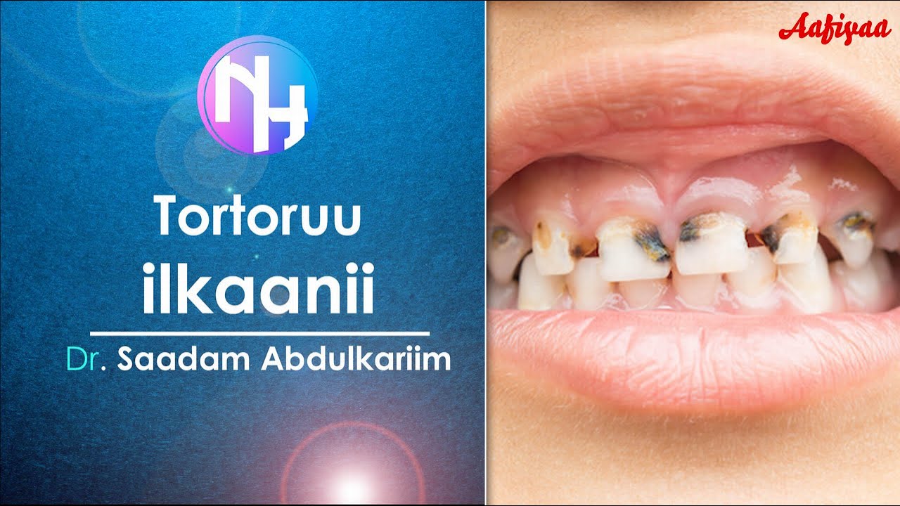 Aafiyaa: Tortoruu ilkaanii, Dr. Saadam Abdulkariim