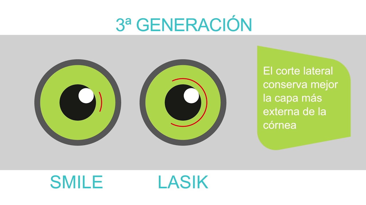 Cirugía refractiva corneal: PRK, LASIK y SMILE