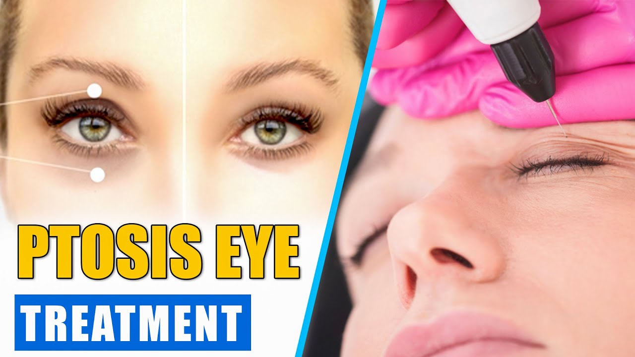 Ptosis Surgery | Ptosis of the Eye Explained | Ptosis Eye Treatment (Eyelid Surgery)