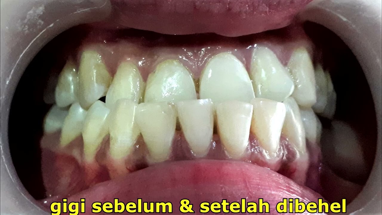 8 bulan behel gigi perawatan mengatasi gigi cakil, dokter gigi Jogja menjelaskan