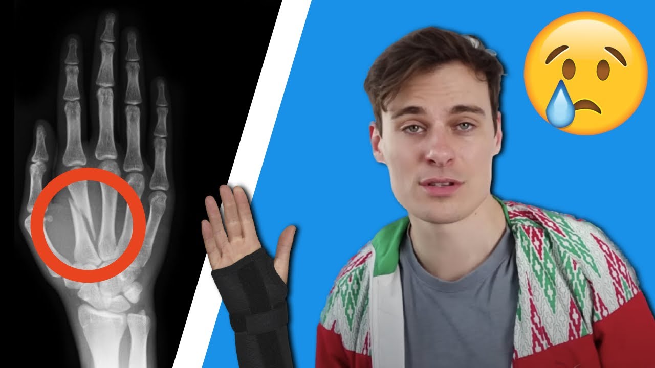 I broke my hand :'(