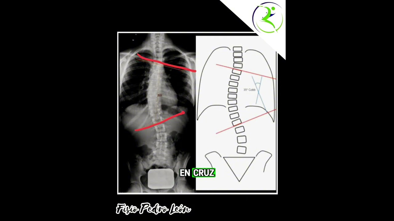 Escoliosis Medición del Ángulo de Cob