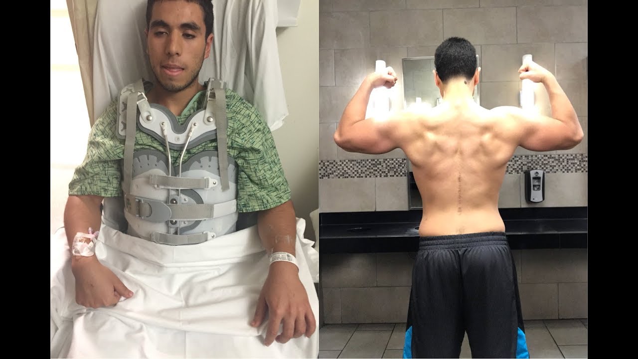 21 Month Spinal Surgery Recovery & 9 Month Body Transformation -Inspirational Weight Loss Motivation