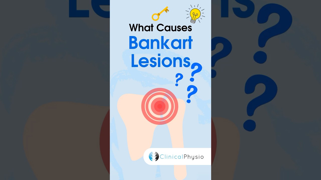Bankart Lesions Explained #physicaltherapy #physiotherapy #shoulder