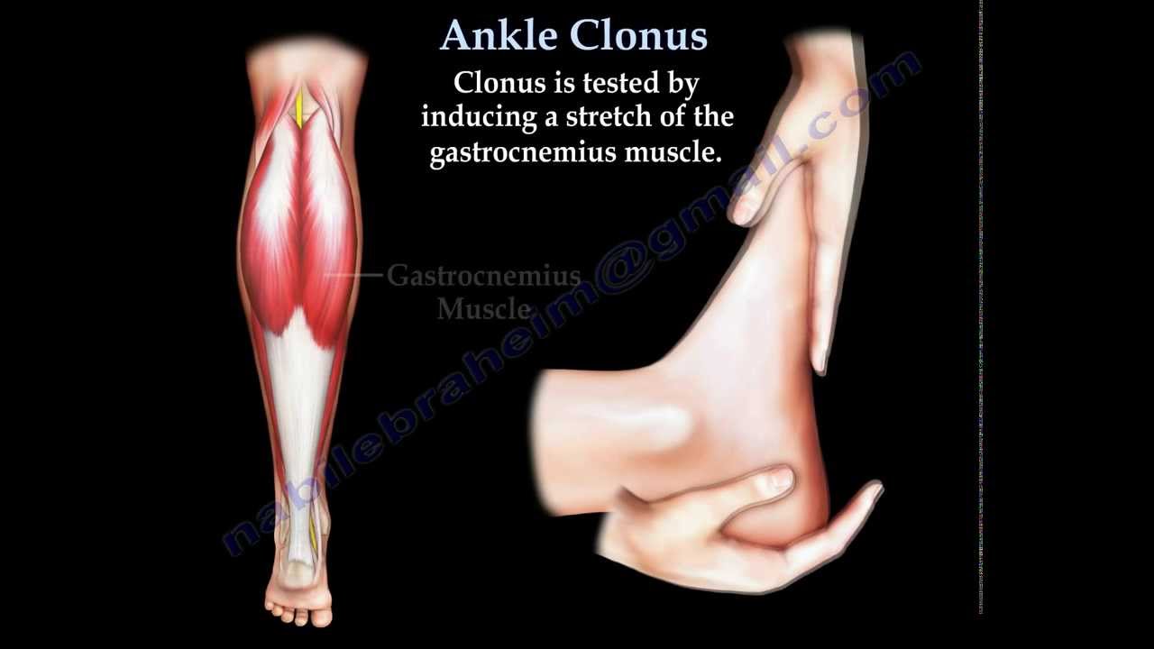 Ankle Clonus - Everything You Need To Know - Dr. Nabil Ebraheim