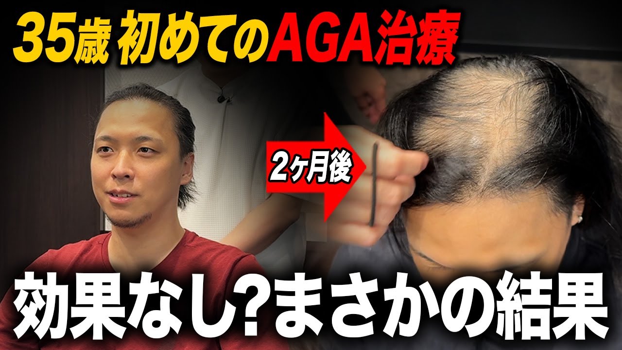【AGA治療2ヶ月目】ミノタブの副作用？抜け毛の増加と体毛の濃さに悩む35歳の本音。