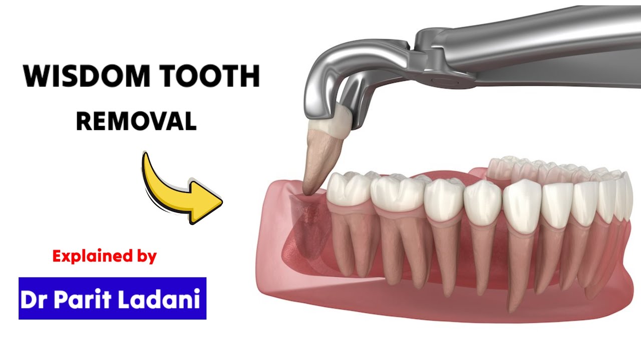 How Painful is Wisdom Tooth Removal? |  Expert Insights and Tips.