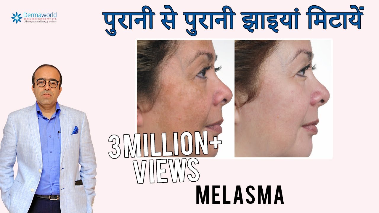 पुरानी से पुरानी झाइयां हटाए | Melasma : causes , precautions and treatment | Dark Spots