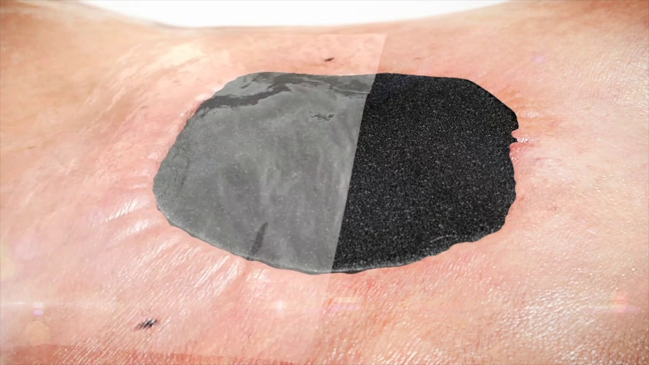 RENASYS&loz; TOUCH Negative Pressure Wound Therapy - Foam Dressing Kit Application Guide