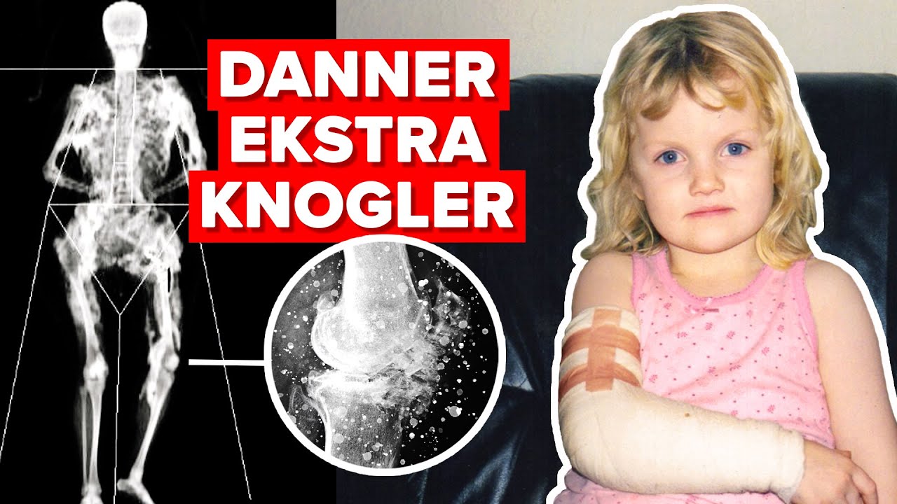 Julies muskler omdannes til knogler – Uhelbredeligt syg med FOP