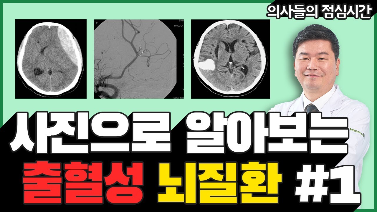 사진을 통해 알아보는 출혈성 뇌질환 (뇌졸중) Part.1