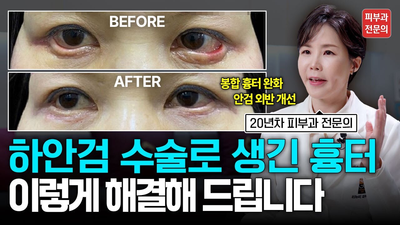 하안검 수술 흉터, 재수술 절대 하지말고 이렇게 해결하세요