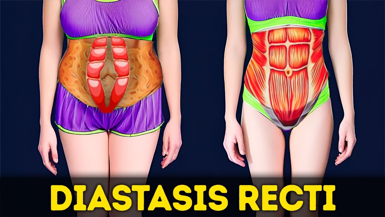Diastasis Recti, Weak Belly Muscles, or Mommy Belly | Simple Exercises to Fix