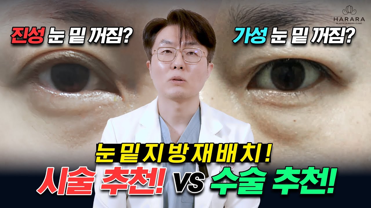 눈밑볼록 뛰어나온 지방 해결 방법 시술 수술? 🐸 | 눈밑지방재배치 1편
