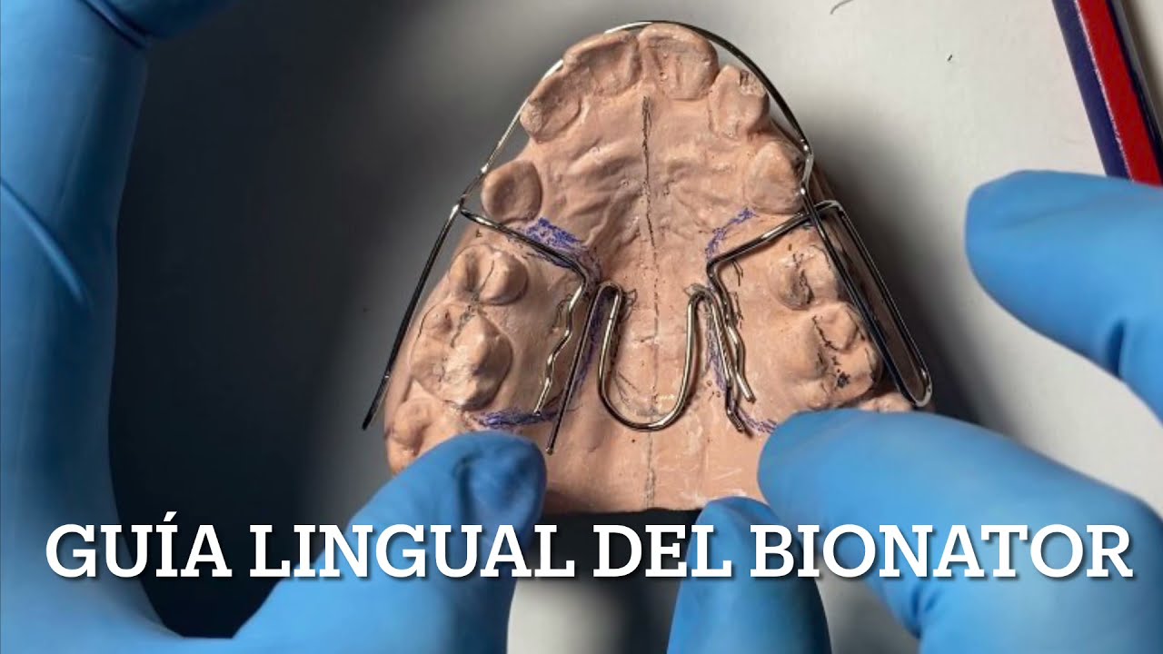 Guía Lingual Del Bionator