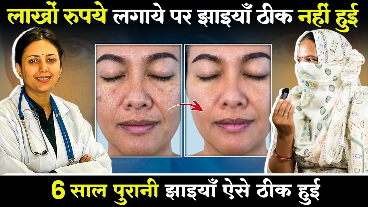 6 साल पुरानी झाइयों को ऐसे किया हमेशा के लिये ठीक | Melasma Jhaiya Treatment | Dr. Upasana Vohra