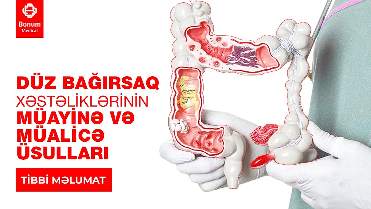 DÜZ BAĞIRSAQ XƏSTƏLİKLƏRİNİN MÜAYİNƏ VƏ MÜALİCƏ ÜSULLARI #bonummedical