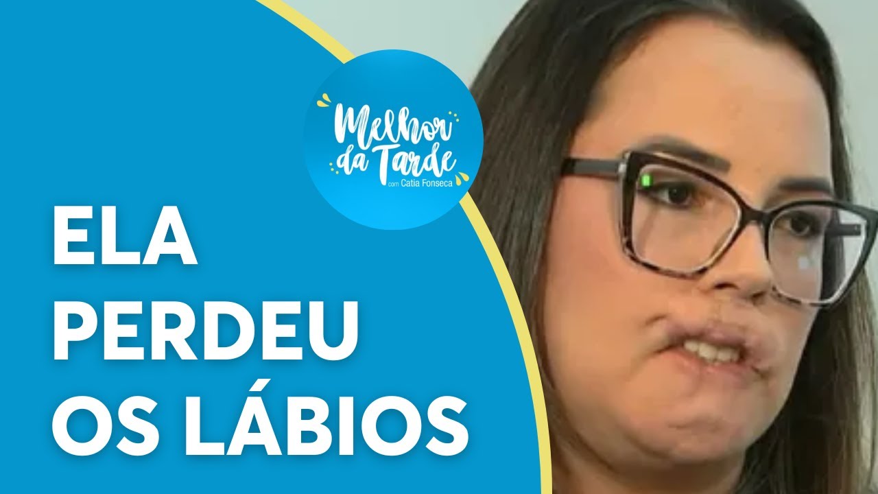Mulher perde os lábios após procedimento estético com PMMA | Melhor da Tarde