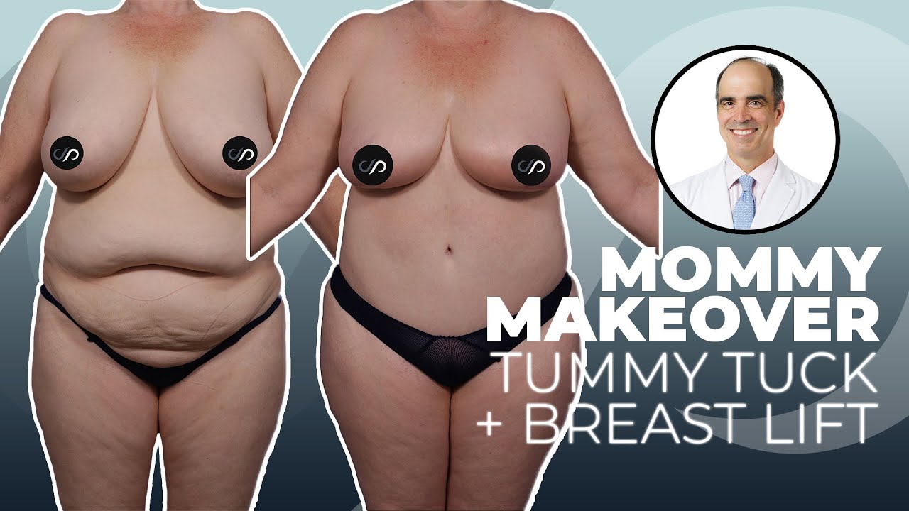 Mommy Makeover: How to Lose Weight Quickly | Dr. David Stoker