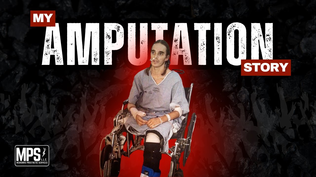 How I became an Amputee and My background in Prosthetics