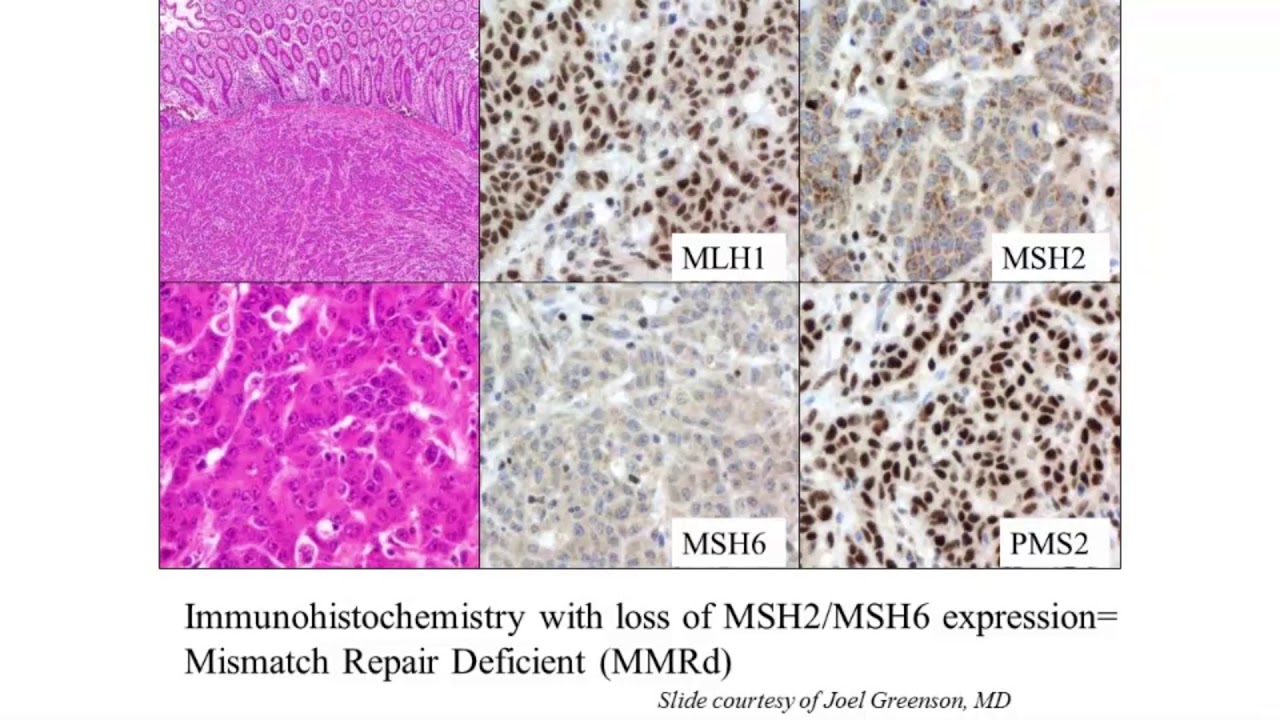 Когда, почему и как применять молекулярно-генетическое тестирование при полипах и раке толстой кишки