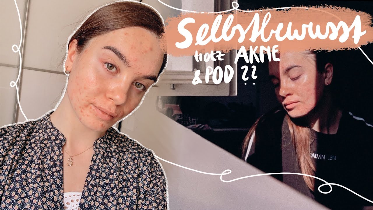 Selbstbewusst trotz Akne & Perioraler Dermatitis - Goldene Milch, Pille etc.