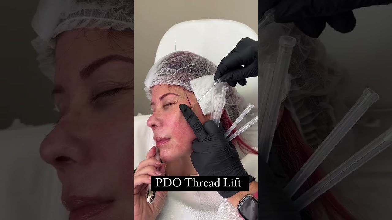 Transform your looks with PDO threadlift 🕊